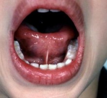 Sapet jezik (Ankyloglossia)