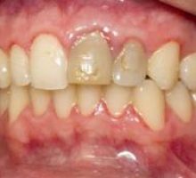 Povrede zuba kod djece
