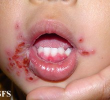 Herpetični stomatitis kod djece