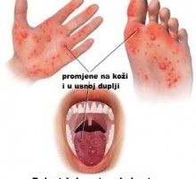 U Pljevljima od septembra 25 djece imalo bolest šaka, stopala i usta