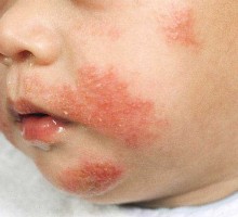 Atopijski dermatitis ili ekcem