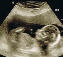 Stručnjaci zabrinuti zbog velikog broja UZV pregleda tokom trudnoće