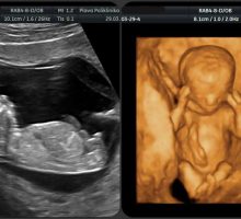 Ultrazvučni pregledi u trudnoći – ekspertni i kontrolni