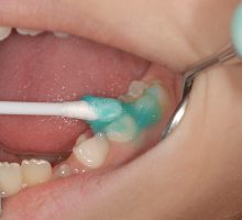 Zalivanje fisura i fluorizacija zuba su na teret zdravstvenog osiguranja