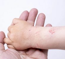 Naredna dva dana preventivni pregledi djece sa atopijskim dermatitisom